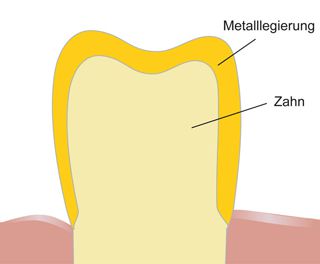 Illustration einer Vollgusskrone